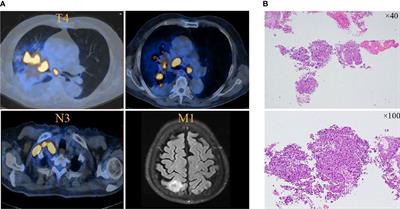 Case report: A rare case of neutropenia caused by pembrolizumab in squamous lung cancer and literature review